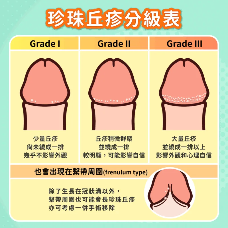 珍珠丘疹分級表