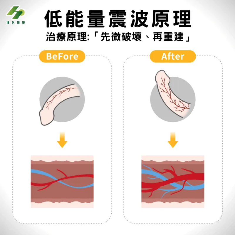 低能量震波原理-BA對比