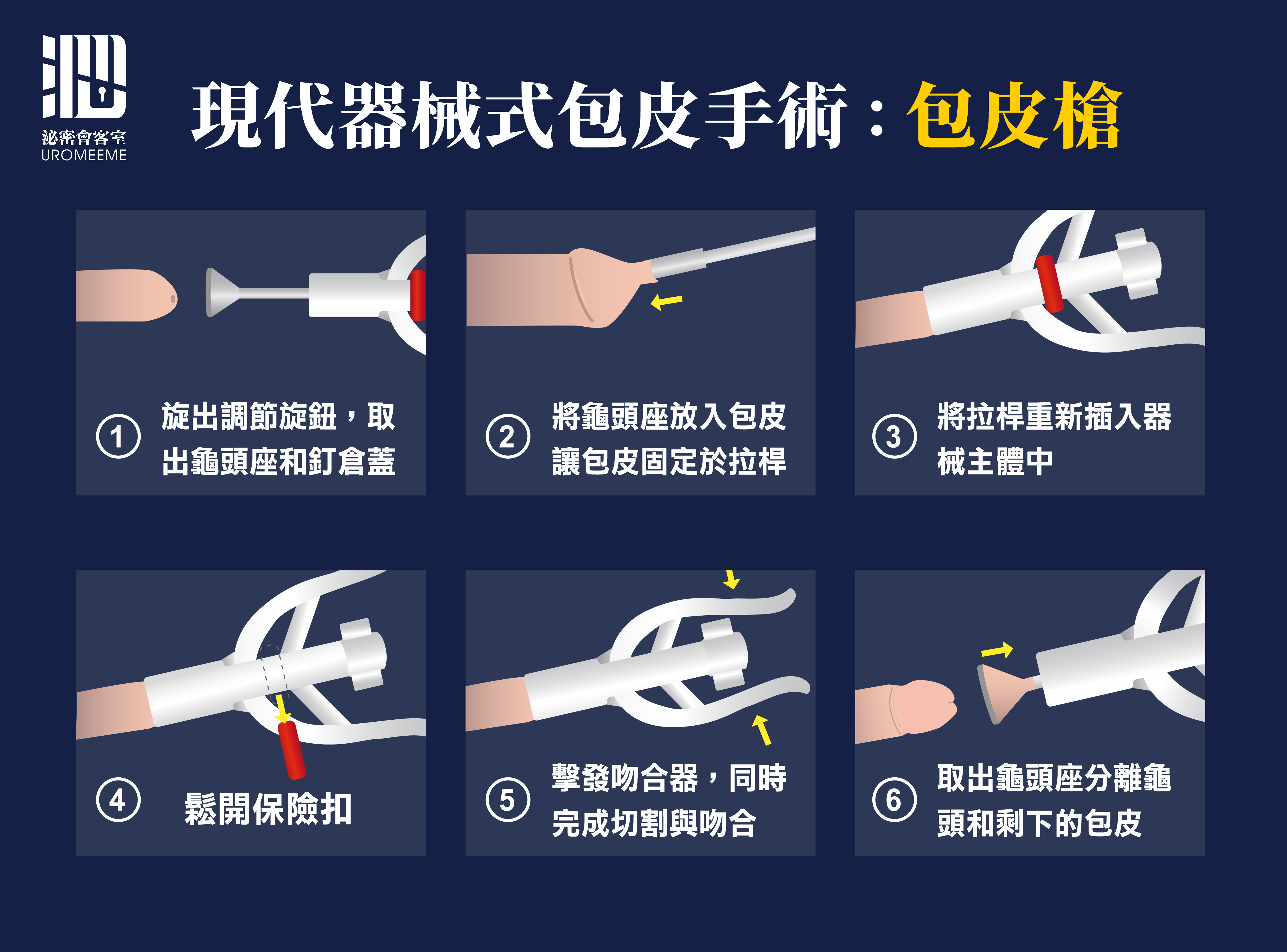 割包皮手術怎麼選|包皮槍,台北泌尿科推薦,割包皮健保,包皮槍保險