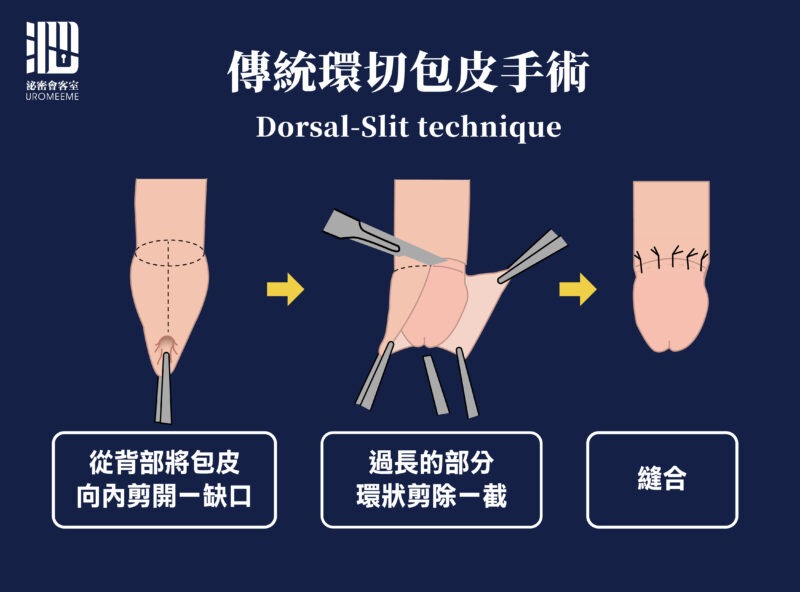 選擇割包皮手術|包皮槍,台北泌尿科推薦,割包皮健保,恢復,包皮槍保險,費用