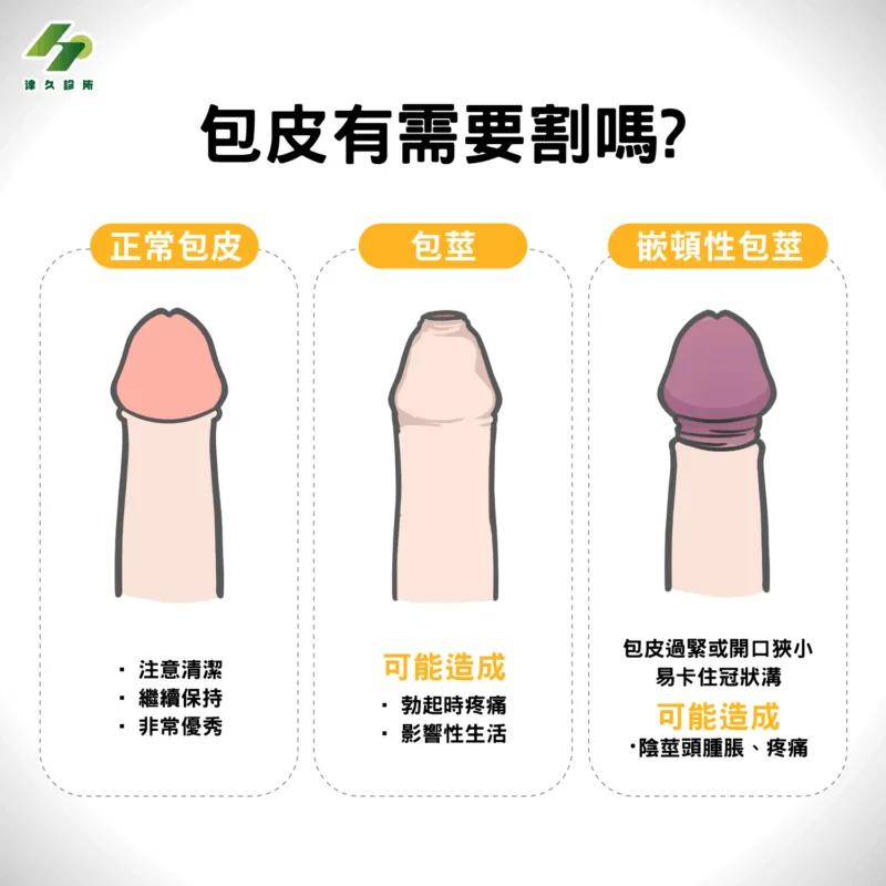 包皮有需要割嗎