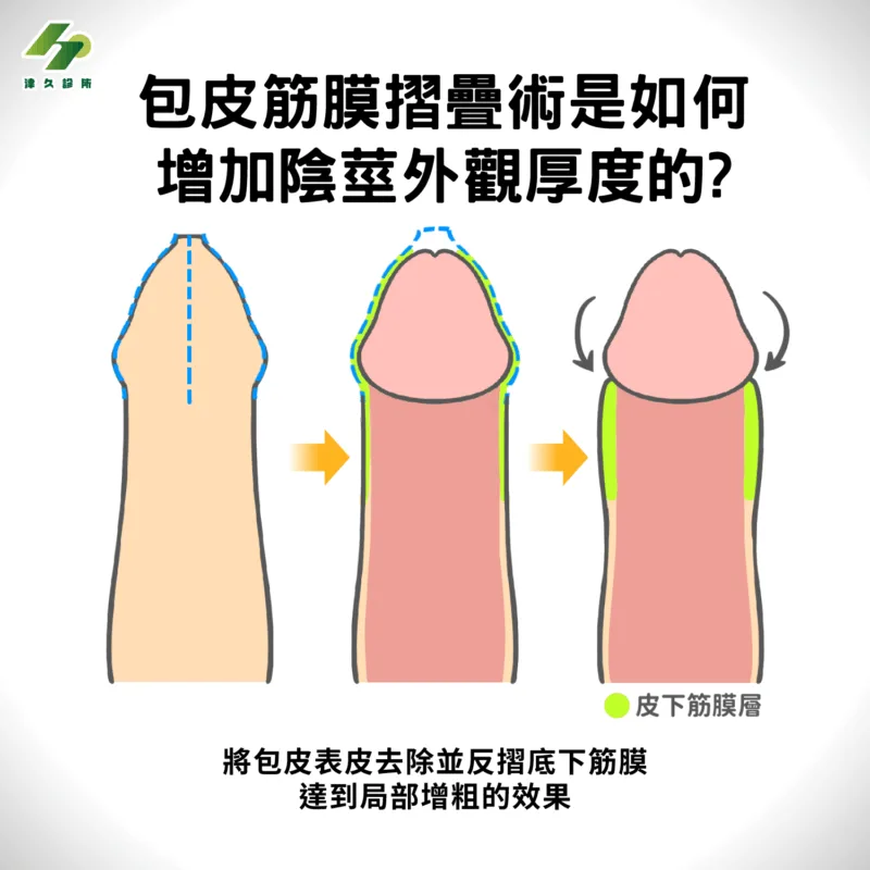 包皮筋膜摺疊術是如何增加陰莖外觀厚度的