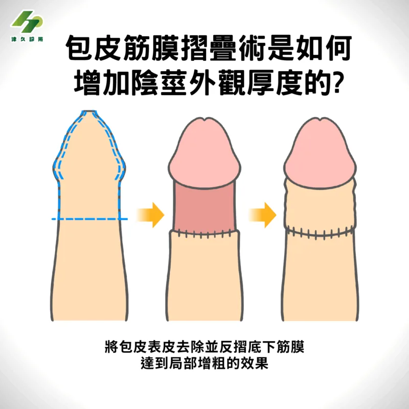 包皮筋膜摺疊術是如何增加陰莖外觀厚度的